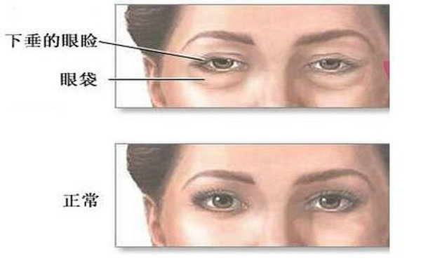 內(nèi)吸<a href=http://www.sbs17.com/listinfo-708-0.html target=_blank class=infotextkey>去眼袋</a>能維持多久?