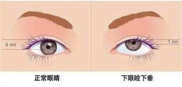 眼皮下垂做什么手術(shù)好