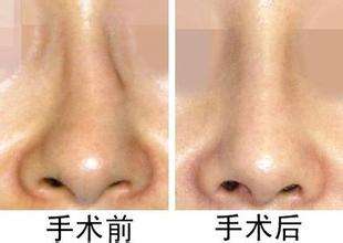 <a href=http://www.sbs17.com/listinfo-751-0.html target=_blank class=infotextkey>歪鼻矯正</a>術(shù)前須知