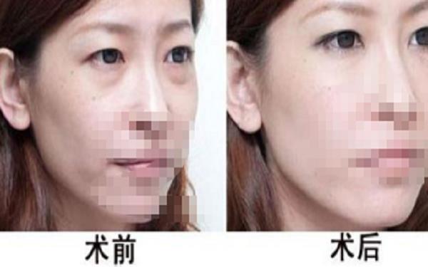 內(nèi)吸眼袋后多久能洗臉?