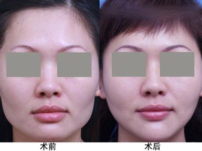 <a href=http://www.sbs17.com/listinfo-685-0.html target=_blank class=infotextkey>吸脂</a><a href=http://www.sbs17.com/listinfo-631-0.html target=_blank class=infotextkey>瘦臉</a>后的需要注意什么