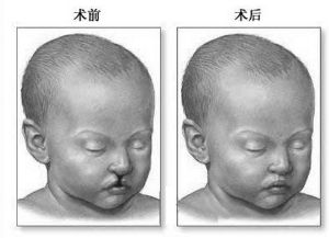 小孩疤痕修復(fù)好的時(shí)間