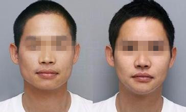 男的打<a href=http://www.sbs17.com/listinfo-631-0.html target=_blank class=infotextkey>瘦臉</a><a href=http://www.sbs17.com/listinfo-614-0.html target=_blank class=infotextkey>除皺</a>效果