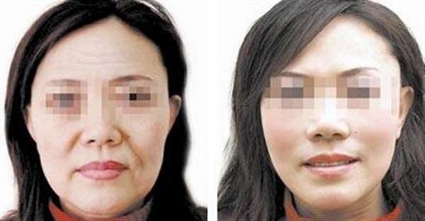 開刀拉皮手術(shù)過程