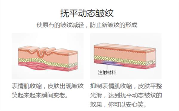 注射<a href=http://www.sbs17.com/listinfo-614-0.html target=_blank class=infotextkey>除皺</a>哪種材料比較好?