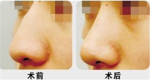 <a href=http://www.sbs17.com/listinfo-756-0.html target=_blank class=infotextkey>駝峰鼻矯正</a>手術(shù)禁忌人群