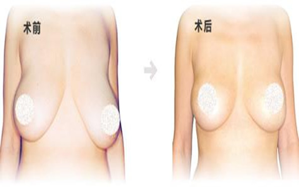 乳房下垂做手術(shù)風險