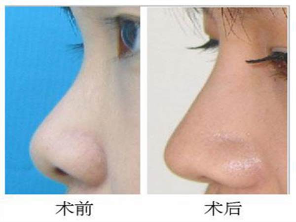 硅膠<a href=http://www.sbs17.com/listinfo-737-0.html target=_blank class=infotextkey>隆鼻</a>的價位