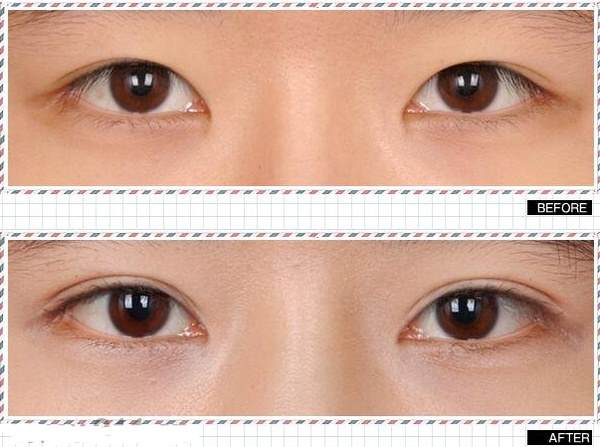 做<a href=http://www.sbs17.com/listinfo-724-0.html target=_blank class=infotextkey>雙眼皮</a>什么季節(jié)好得快
