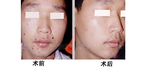 點(diǎn)痦子多少錢(qián)
