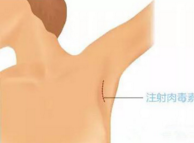 腋下<a href=http://www.sbs17.com/listinfo-614-0.html target=_blank class=infotextkey>除皺</a>瘦型素注射后的注意事項(xiàng)
