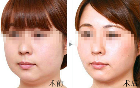 <a href=http://www.sbs17.com/listinfo-631-0.html target=_blank class=infotextkey>瘦臉</a><a href=http://www.sbs17.com/listinfo-614-0.html target=_blank class=infotextkey>除皺</a>第二針隔多久打