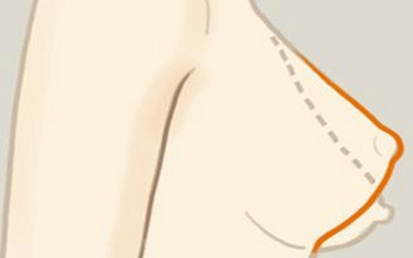 2種<a href=http://www.sbs17.com/listinfo-623-0.html target=_blank class=infotextkey>乳房下垂矯正</a>術(shù)