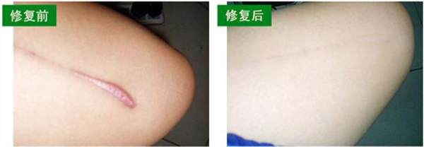 創(chuàng)傷疤痕修復的護理事項
