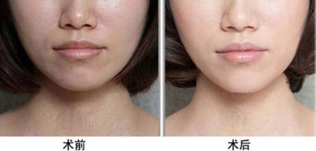 光子<a href=http://www.sbs17.com/listinfo-770-0.html target=_blank class=infotextkey>嫩膚</a>之后注意事項(xiàng)