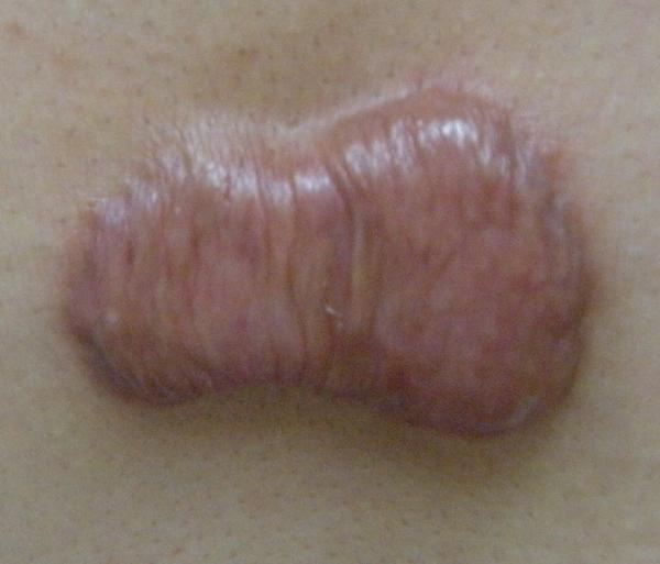 疤痕增生手術切除術