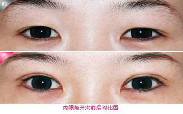 哪里<a href=http://www.sbs17.com/listinfo-711-0.html target=_blank class=infotextkey>開眼角</a>較好?
