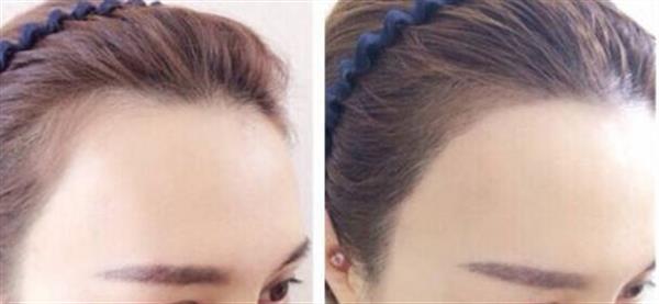 發(fā)際線整形真的是長期有效的嗎