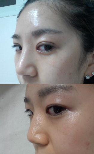 硅膠<a href=http://www.sbs17.com/listinfo-737-0.html target=_blank class=infotextkey>隆鼻</a>容易排異嗎