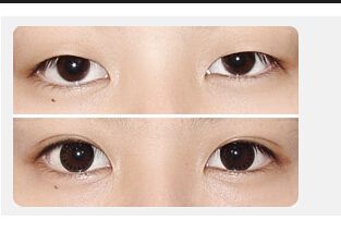 割<a href=http://www.sbs17.com/listinfo-724-0.html target=_blank class=infotextkey>雙眼皮</a>有年齡限制嗎