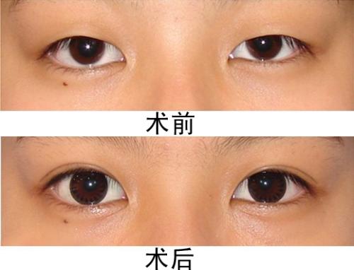 割<a href=http://www.sbs17.com/listinfo-724-0.html target=_blank class=infotextkey>雙眼皮</a><a href=http://www.sbs17.com/listinfo-711-0.html target=_blank class=infotextkey>開眼角</a>多少錢 割<a href=http://www.sbs17.com/listinfo-724-0.html target=_blank class=infotextkey>雙眼皮</a><a href=http://www.sbs17.com/listinfo-711-0.html target=_blank class=infotextkey>開眼角</a>費(fèi)用