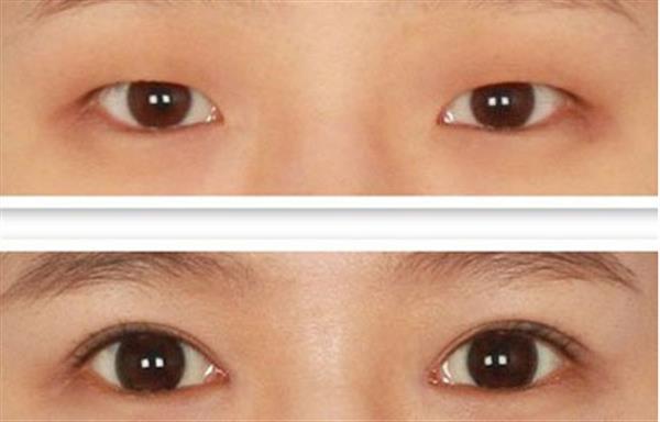 多層褶皺<a href=http://www.sbs17.com/listinfo-724-0.html target=_blank class=infotextkey>雙眼皮</a>怎么樣