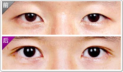 做個<a href=http://www.sbs17.com/listinfo-724-0.html target=_blank class=infotextkey>雙眼皮</a>要多少錢