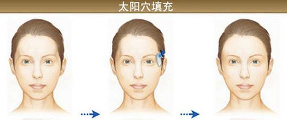 透明質(zhì)酸<a href=http://www.sbs17.com/listinfo-630-0.html target=_blank class=infotextkey>豐太陽(yáng)穴</a>一般需要打幾支