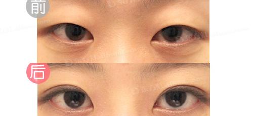 切開<a href=http://www.sbs17.com/listinfo-724-0.html target=_blank class=infotextkey>雙眼皮</a>注意事項