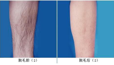 冰點<a href=http://www.sbs17.com/listinfo-670-0.html target=_blank class=infotextkey>脫毛</a>后需要怎樣護理