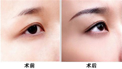 紋眉后眼皮腫多久能好