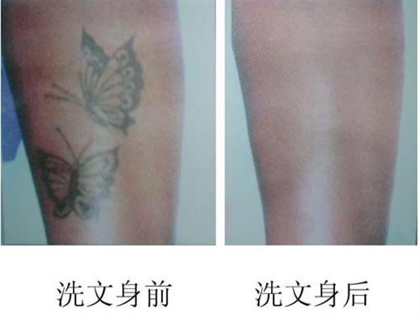 激光<a href=http://www.sbs17.com/listinfo-793-0.html target=_blank class=infotextkey>洗紋身</a>能用麻藥嗎