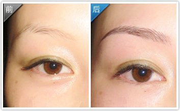 激光<a href=http://www.sbs17.com/listinfo-658-0.html target=_blank class=infotextkey>洗眉</a>太深會留疤嗎