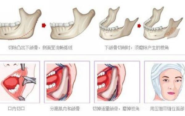 下<a href=http://www.sbs17.com/listinfo-644-0.html target=_blank class=infotextkey>頜骨整形</a>危險(xiǎn)嗎