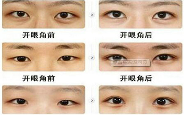 哪種眼睛適合<a href=http://www.sbs17.com/listinfo-711-0.html target=_blank class=infotextkey>開眼角</a>?