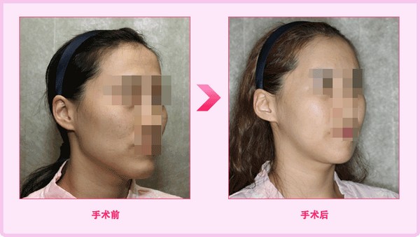 臉兩側(cè)骨頭突出怎么辦