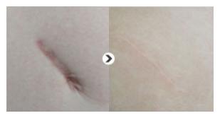 凹陷性疤痕的治療方法是什么？