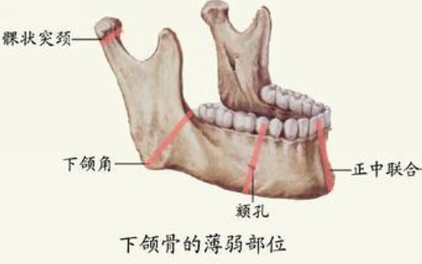 下頜骨骨折手術(shù)多少錢