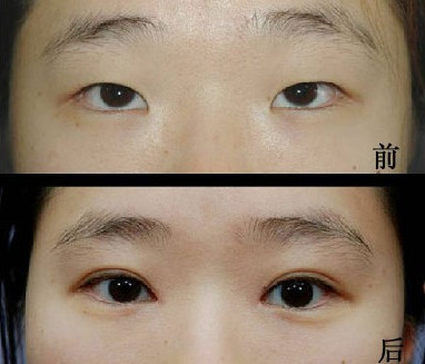 埋線<a href=http://www.sbs17.com/listinfo-724-0.html target=_blank class=infotextkey>雙眼皮</a>需要拆線嗎