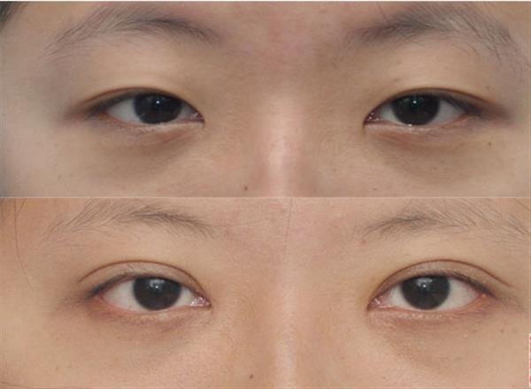 做個(gè)<a href=http://www.sbs17.com/listinfo-711-0.html target=_blank class=infotextkey>開(kāi)眼角</a><a href=http://www.sbs17.com/listinfo-724-0.html target=_blank class=infotextkey>雙眼皮</a>多少錢(qián)