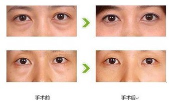 <a href=http://www.sbs17.com/listinfo-708-0.html target=_blank class=infotextkey>去眼袋</a>的缺點