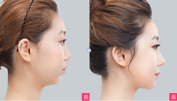 硅膠<a href=http://www.sbs17.com/listinfo-737-0.html target=_blank class=infotextkey>隆鼻</a>多久消腫