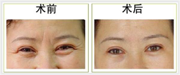 魚尾紋<a href=http://www.sbs17.com/listinfo-614-0.html target=_blank class=infotextkey>除皺</a>抗衰安全嗎