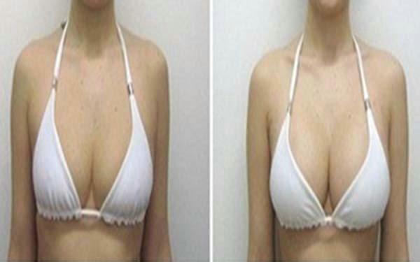 假體<a href=http://www.sbs17.com/listinfo-618-0.html target=_blank class=infotextkey>隆胸</a>后須謹記事項