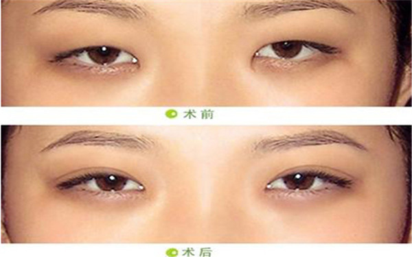 正規(guī)<a href=http://www.sbs17.com/listinfo-711-0.html target=_blank class=infotextkey>開眼角</a>手術多少錢