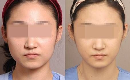 打下巴要多少錢
