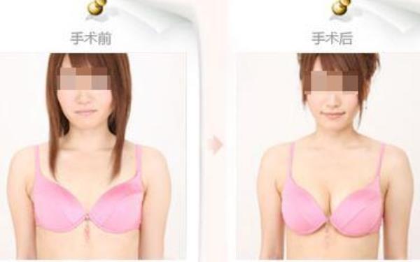 注射豐胸大概多少錢(qián)