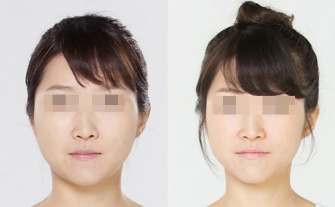 打<a href=http://www.sbs17.com/listinfo-631-0.html target=_blank class=infotextkey>瘦臉</a><a href=http://www.sbs17.com/listinfo-614-0.html target=_blank class=infotextkey>除皺</a>多久吃消炎藥