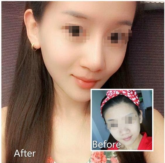 打<a href=http://www.sbs17.com/listinfo-631-0.html target=_blank class=infotextkey>瘦臉</a><a href=http://www.sbs17.com/listinfo-614-0.html target=_blank class=infotextkey>除皺</a>可以喝酒嗎