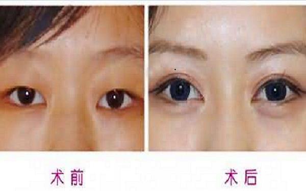 <a href=http://www.sbs17.com/listinfo-724-0.html target=_blank class=infotextkey>雙眼皮</a>埋線的壞處